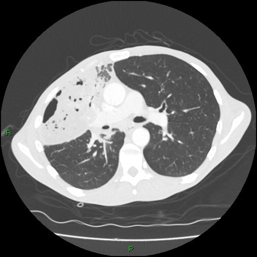 Acute right lung abscess (Radiopaedia 34806-36258 Axial lung window 83).jpg