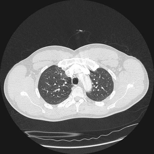 Acute segmental pulmonary emboli and pulmonary infarction (Radiopaedia 62264-70444 Axial lung window 43).jpg
