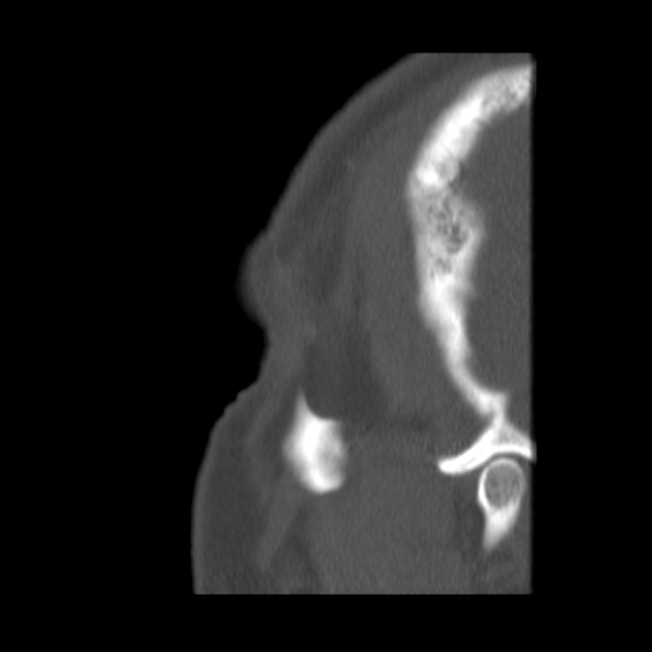 Acute sinusitis (Radiopaedia 23161-23215 Sagittal bone window 61).jpg