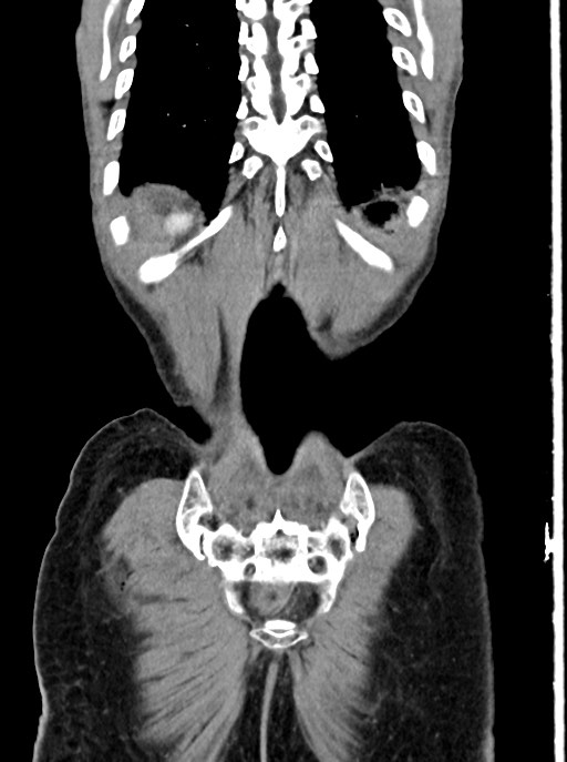 Acute small bowel (ileal) volvulus (Radiopaedia 71740-82139 Coronal C+ portal venous phase 101).jpg