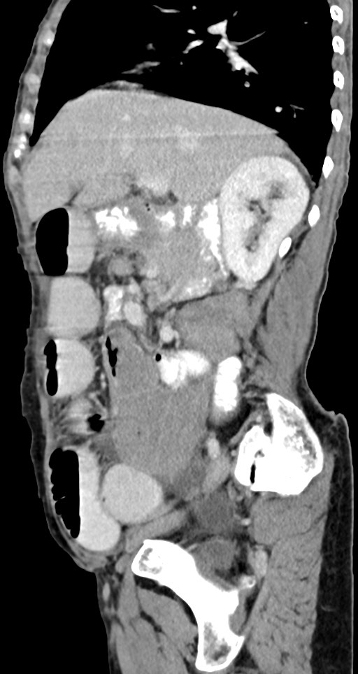 Acute small bowel (ileal) volvulus (Radiopaedia 71740-82139 Sagittal C+ portal venous phase 110).jpg