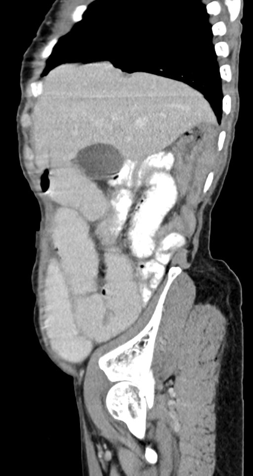 Acute small bowel (ileal) volvulus (Radiopaedia 71740-82139 Sagittal C+ portal venous phase 127).jpg