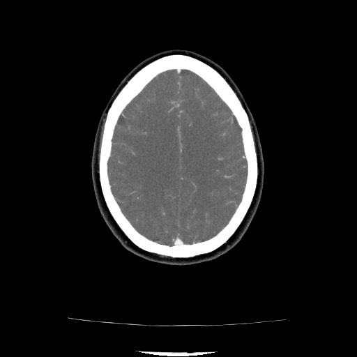 Acute subarachnoid hemorrhage and accessory anterior cerebral artery (Radiopaedia 69231-79009 Axial C+ arterial phase 110).jpg