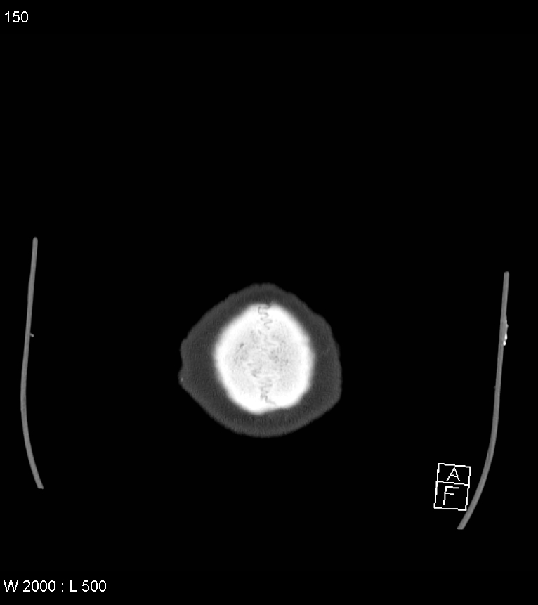 Acute subdural hematoma with myelofibrosis (Radiopaedia 52582-58494 Axial bone window 75).jpg