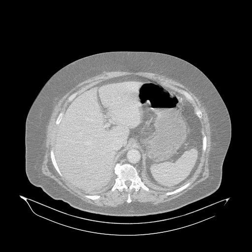 Acute superior mesenteric artery occlusion (Radiopaedia 51288-56960 Axial lung window 1).jpg