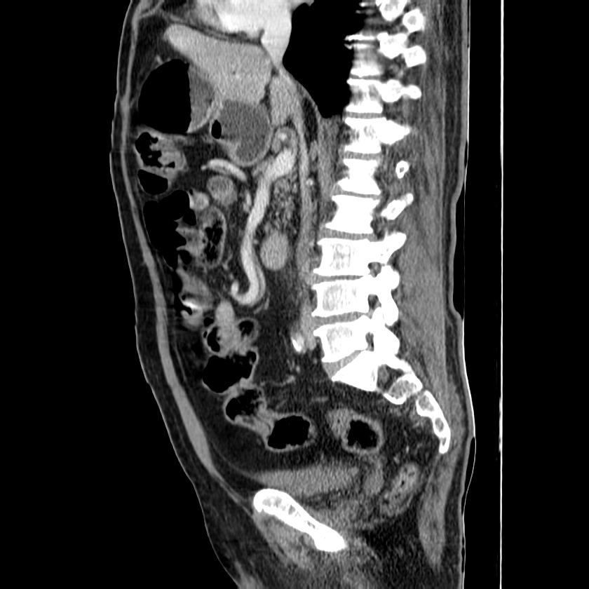 Adenocarcinoma of colon with entero-colic fistula (Radiopaedia 22832-22852 Sagittal C+ portal venous phase 30).jpg