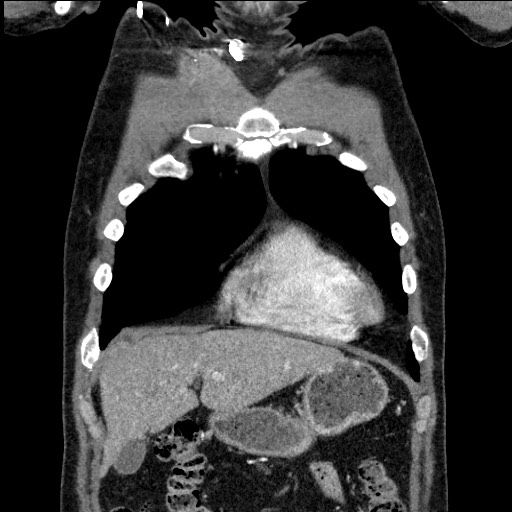File:Adenocarcinoma of the lung (Radiopaedia 59871-67325 Coronal C+ arterial phase 12).jpg