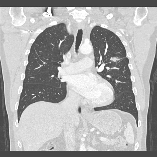 Adenocarcinoma of the lung (Radiopaedia 59871-67325 Coronal lung window 28).jpg