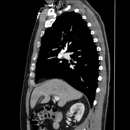 Adenocarcinoma of the lung (Radiopaedia 59871-67325 Sagittal C+ arterial phase 35).jpg