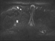 Adenocarcioma of rectum- T1 lesion (Radiopaedia 36921-38546 Axial DWI 32).png