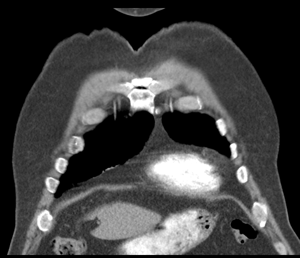 Adenocarcioma of rectum- T1 lesion (Radiopaedia 36921-38547 Coronal C+ arterial phase 15).png