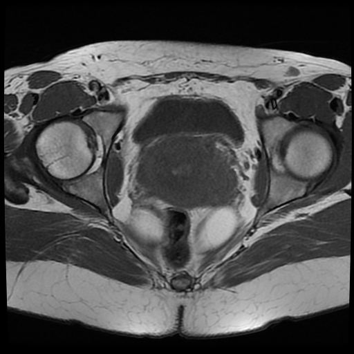 File:Adenomyosis-scar endometriosis (Radiopaedia 65863-75022 Axial T1 22).jpg
