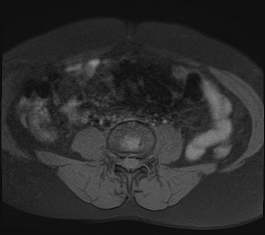 File:Adenomyosis - ovarian endometriomas (Radiopaedia 67031-76350 Axial T1 fat sat 1).jpg