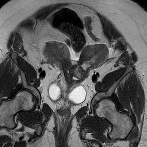 File:Adenomyosis within a didelphys uterus (Radiopaedia 70175-80215 Coronal T2 13).jpg