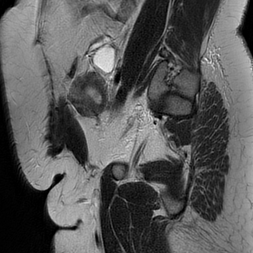 File:Adenomyosis within a didelphys uterus (Radiopaedia 70175-80215 Sagittal T2 30).jpg