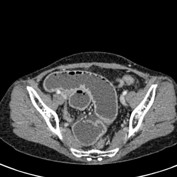 Adhesional small bowel obstruction (Radiopaedia 48397-53305 Axial C+ portal venous phase 76).jpg