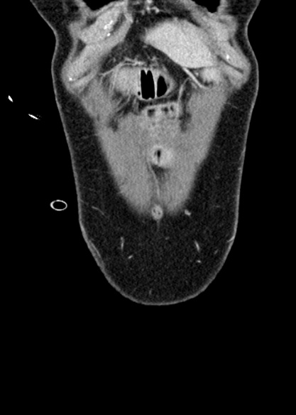 File:Adhesional small bowel obstruction (Radiopaedia 48397-53305 Coronal C+ portal venous phase 38).jpg