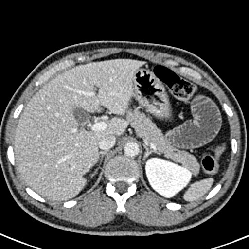 File:Adhesional small bowel obstruction (Radiopaedia 58900-66131 Axial C+ portal venous phase 13).jpg