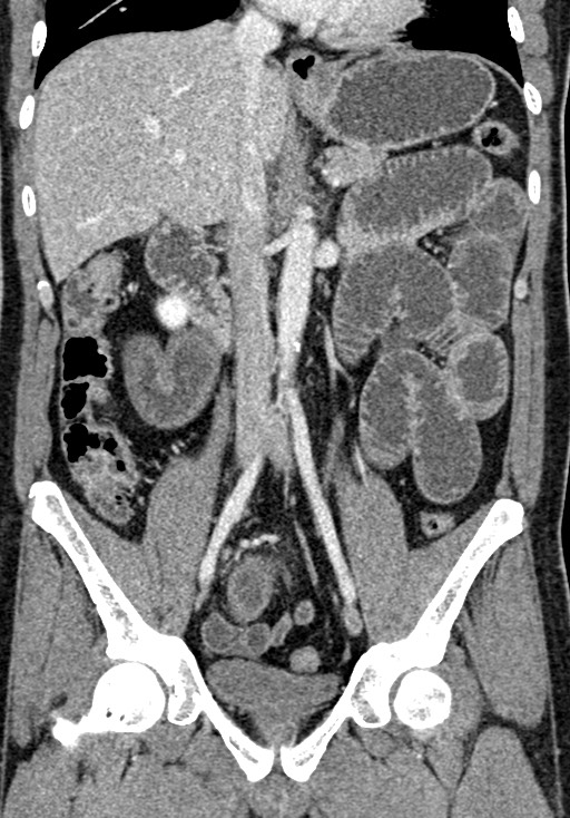 Adhesional small bowel obstruction (Radiopaedia 58900-66131 Coronal C+ portal venous phase 142).jpg