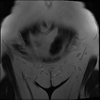 File:Adnexal multilocular cyst (O-RADS US 3- O-RADS MRI 3) (Radiopaedia 87426-103754 Coronal T2 3).jpg