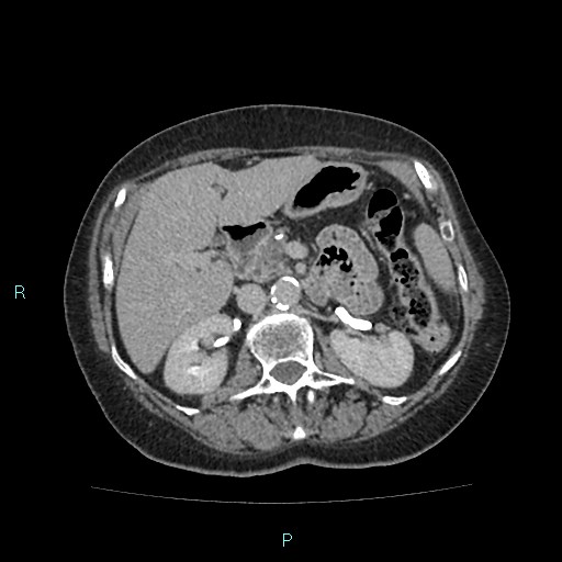 File:Adrenal collision tumor (ACT) (Radiopaedia 48462-53379 Axial C+ delayed 24).jpg