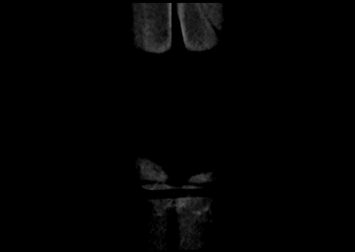 Adrenal cortical carcinoma (Radiopaedia 64017-72769 Coronal C+ portal venous phase 60).jpg