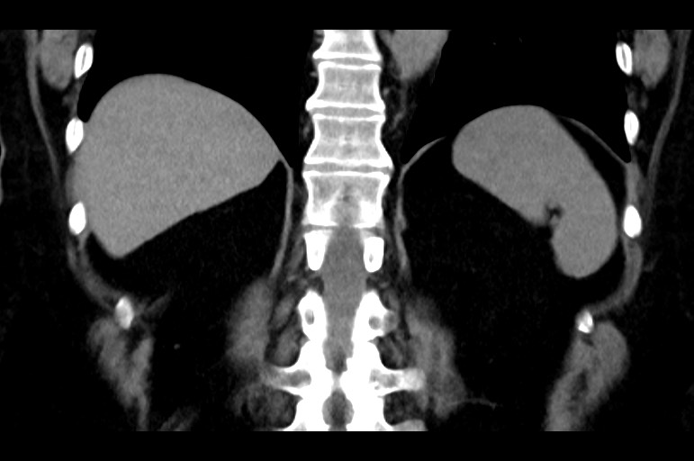 Adrenal cortical carcinoma (Radiopaedia 64017-72769 Coronal non-contrast 42).jpg