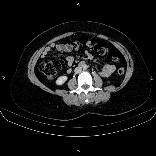 Adrenal cortical carcinoma (Radiopaedia 84882-100379 Axial C+ delayed 47).jpg