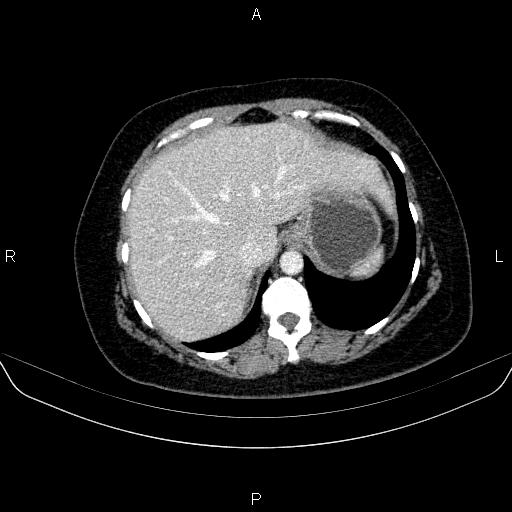 Adrenal cortical carcinoma (Radiopaedia 84882-100379 Axial C+ portal venous phase 14).jpg