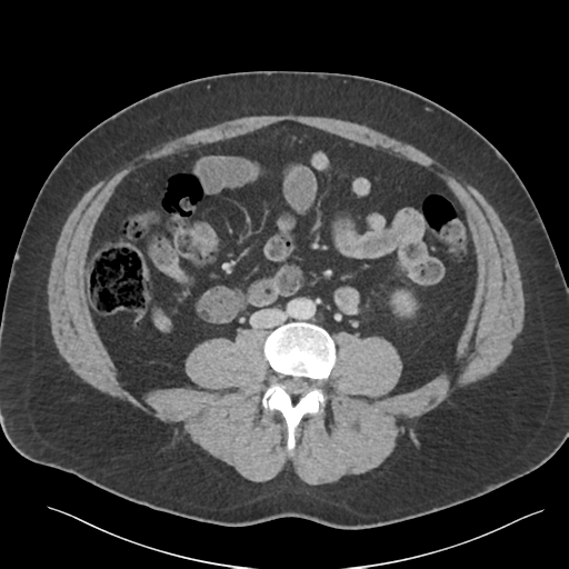File:Adrenal cyst (Radiopaedia 45625-49777 Axial C+ portal venous phase 61).png