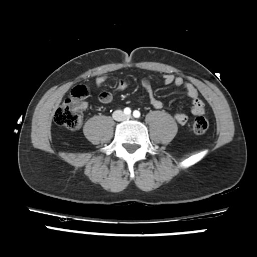 File:Adrenal gland trauma (Radiopaedia 81351-95078 Axial Dual bolus trauma C+ 90).jpg