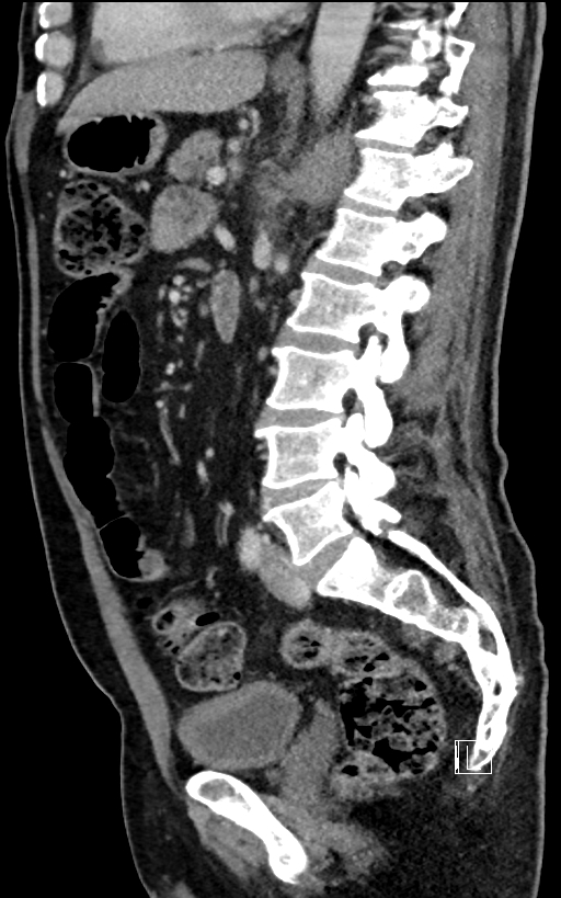 Adrenal lymphoma (Radiopaedia 73730-84529 Sagittal C+ portal venous phase 64).jpg
