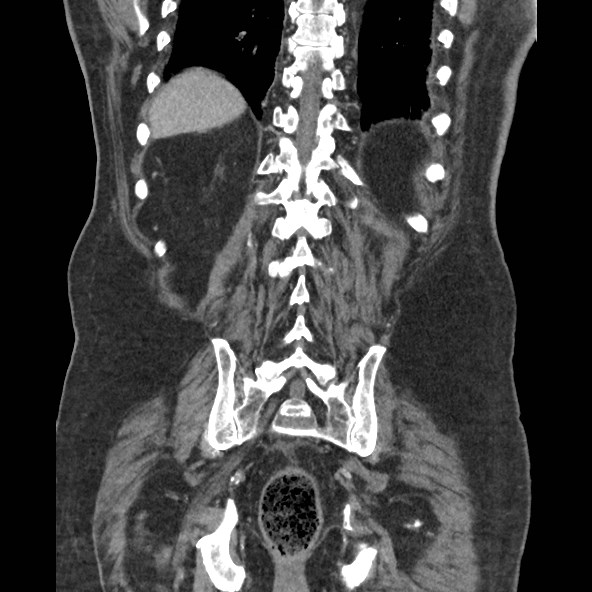 Adrenal lymphoma (Radiopaedia 84145-99415 Coronal C+ portal venous phase 72).jpg
