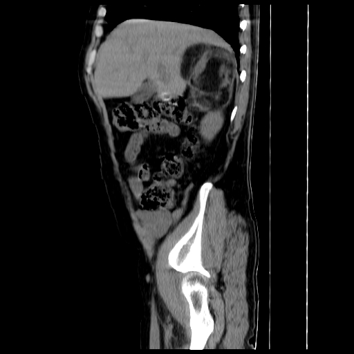 File:Adrenal myelolipoma (Radiopaedia 41843-44834 Sagittal non-contrast 5).jpg