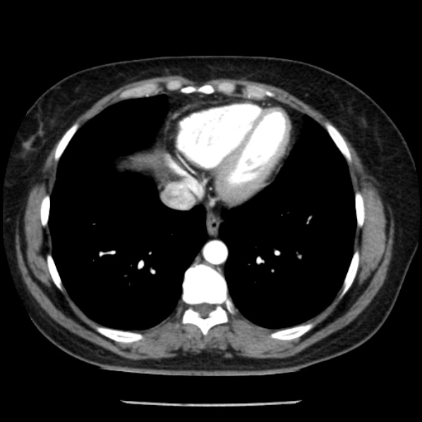 Adrenal myelolipoma (Radiopaedia 43401-46759 Axial C+ arterial phase 4).jpg