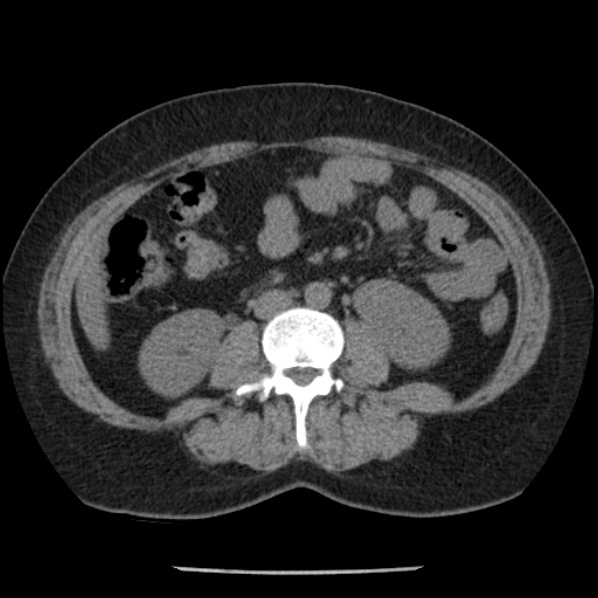 Adrenal myelolipoma (Radiopaedia 43401-46759 Axial non-contrast 45).jpg
