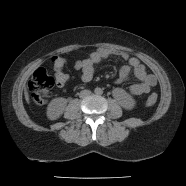 Adrenal myelolipoma (Radiopaedia 43401-46759 Axial non-contrast 47).jpg