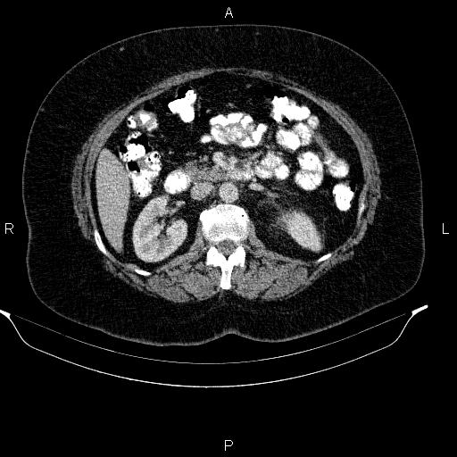 Adrenal myelolipoma (Radiopaedia 84319-99617 Axial renal cortical phase 50).jpg