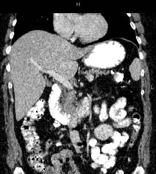 Adrenal myelolipoma (Radiopaedia 84319-99617 Coronal renal cortical phase 35).jpg