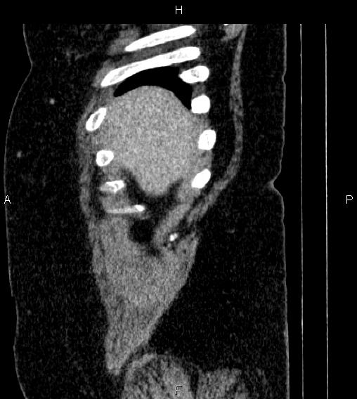 Adrenal myelolipoma (Radiopaedia 84319-99617 Sagittal renal cortical phase 5).jpg