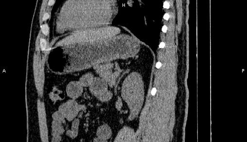Adrenal myelolipoma (Radiopaedia 84321-99619 Sagittal non-contrast 72).jpg