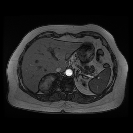 File:Adrenal myelolipoma - MRI (Radiopaedia 83249-97646 T1 out-of-phase 5).jpg