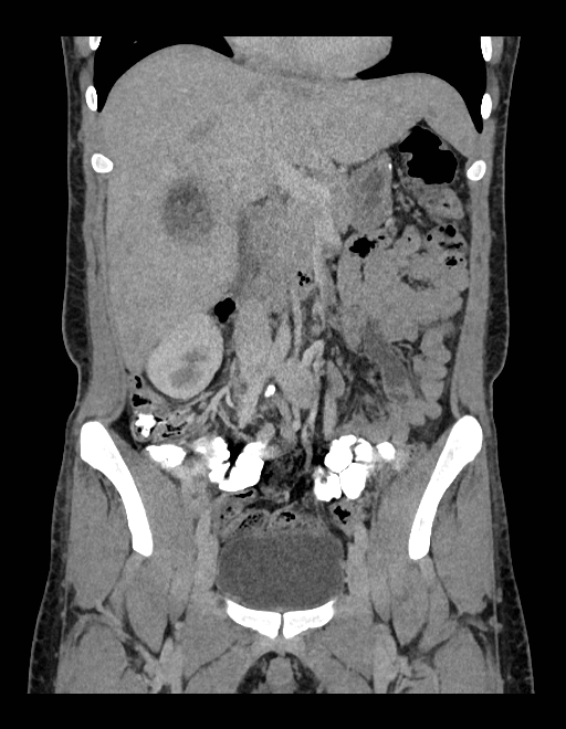 Adrenal myelolipoma - bilateral (Radiopaedia 74805-85810 Coronal C+ portal venous phase 178).jpg