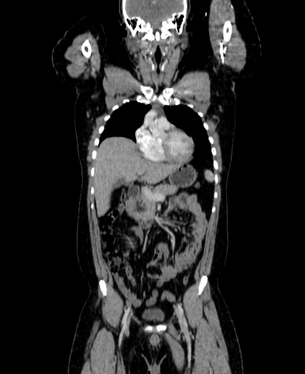 Adrenocortical carcinoma (Radiopaedia 80134-93438 Coronal C+ portal venous phase 63).jpg
