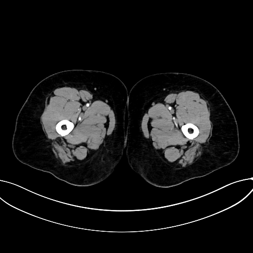 Adrenocortical carcinoma (Radiopaedia 87281-103569 Axial C+ arterial phase 103).jpg