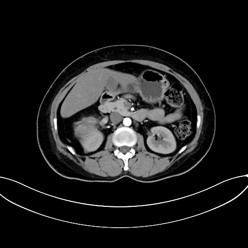 Adrenocortical carcinoma (Radiopaedia 87281-103569 Axial C+ arterial phase 37).jpg
