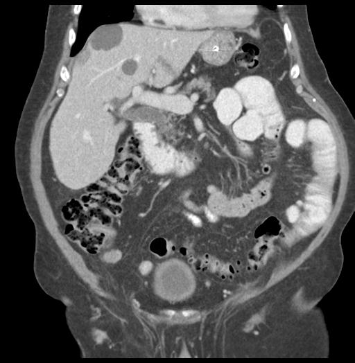 Adult ileal intussusception with secondary obstruction (Radiopaedia 30395-31051 Coronal C+ portal venous phase 25).jpg