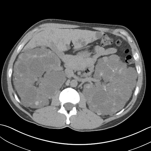 File:Adult polycystic kidney disease (Radiopaedia 47866-52626 Axial non-contrast 29).png