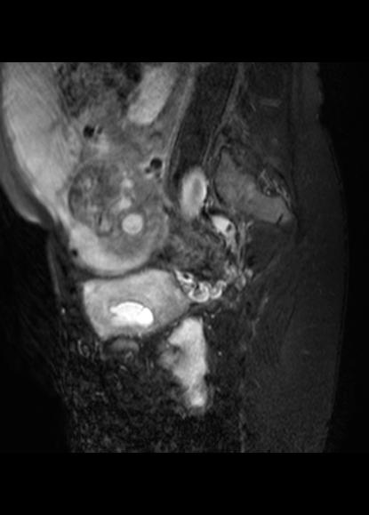 File:Aggressive angiomyxoma of the pelvis and perineum (Radiopaedia 59162-66479 Sagittal T2 fat sat 5).jpg