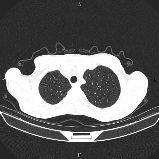 Air bronchogram in pneumonia (Radiopaedia 85719-101512 Axial lung window 12).jpg